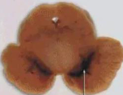 正常人：正常黑质