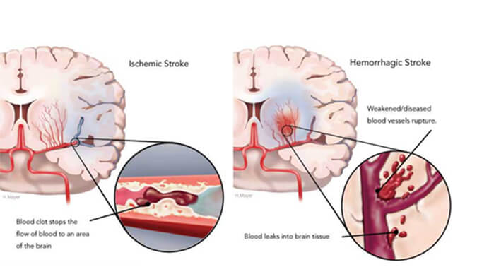 世界卒中日：从动物药效模型评价看心脑血管药物开发